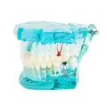 Modèle de restauration dentaire Transparent modèle de dents avec pont détachable modèle