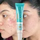 Effective Acne Removal Cream Herbal Anti-Acne Gel Remove Pimple Spot Oil Control Shrink Pores Tight