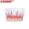 Dental Overdenture Zähne Dental Implantat Zähne Modell Demo Overdenture Restaurierung Mit Implantate
