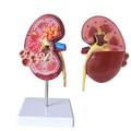 VVHUDA Kidney Pathology Anatomical Model Renal Calculi Model Human Body Visceral Organ Lesion Nephridium Structure Demonstration Teaching Tool for Medical Education small gift