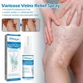 Varicose Veins Treatment Varicocele Vein Removal Spray Vasculitis Phlebitis Vulvar Varicosity Spider