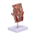 Modello di anatomia modello di lesione di emorroidi rettale umano modello di fistola di emorroidi