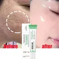 Salicylsäure Poren schrumpfende Creme schnelle Beseitigung große Poren entfernen Blacke head