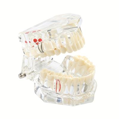 Dental Implant Model Dental Consumables Removable Dental Restoration Model Pathological Tooth Model Active Tooth Model