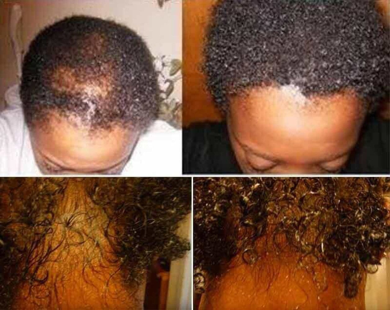 Olio magico per la crescita dei capelli, siero per la ricrescita, perdita di capelli, perdita di capelli negli uomini, perdita di capelli nelle donne,
