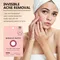 Rael Pimple Patches, Miracle Overnight Spot Cover - Hydrocolloid Acne Patch for Face, Zit & Blemish,