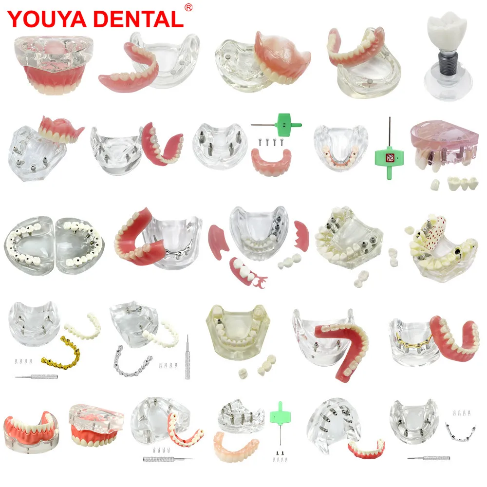 1pc Oberen/Unteren Dental Implantat Modell Kiefer 2/4/6 Implantate Zähne Lehre Modell Zahnmedizin Abnehmbare Studie Modelle für Bildung Demo Image