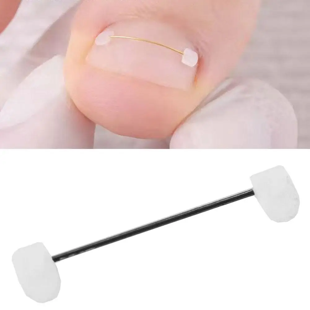 Kieferorthopädische Zahnspangen mit Stahldrahtschnallen, biomimetischem Knochenspeicher und Metallinlage zur Korrektur von Nagelentzündungen Image